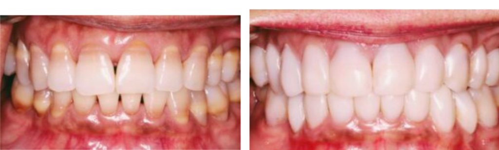 Bioclear Before and After image