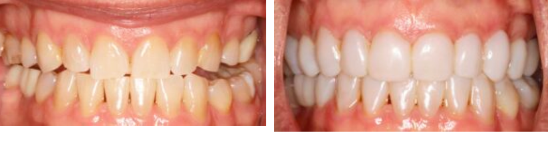 Bioclear Before and After photo