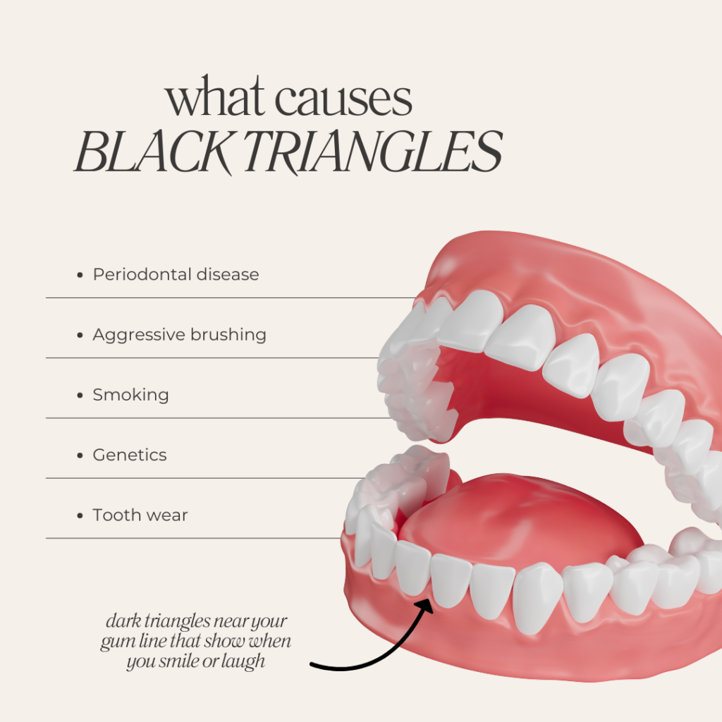 Bioclear Black Triangle Treatment 